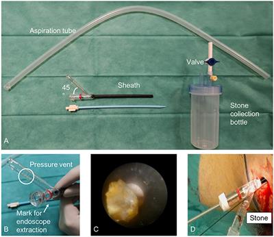 Pediatric Urolithiasis: Current Surgical Strategies and Future Perspectives